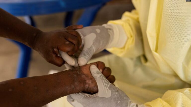 El mpox presenta síntomas similares a la viruela, con inflamación de ganglios y erupciones cutáneas, aunque no existe un tratamiento específico aún.